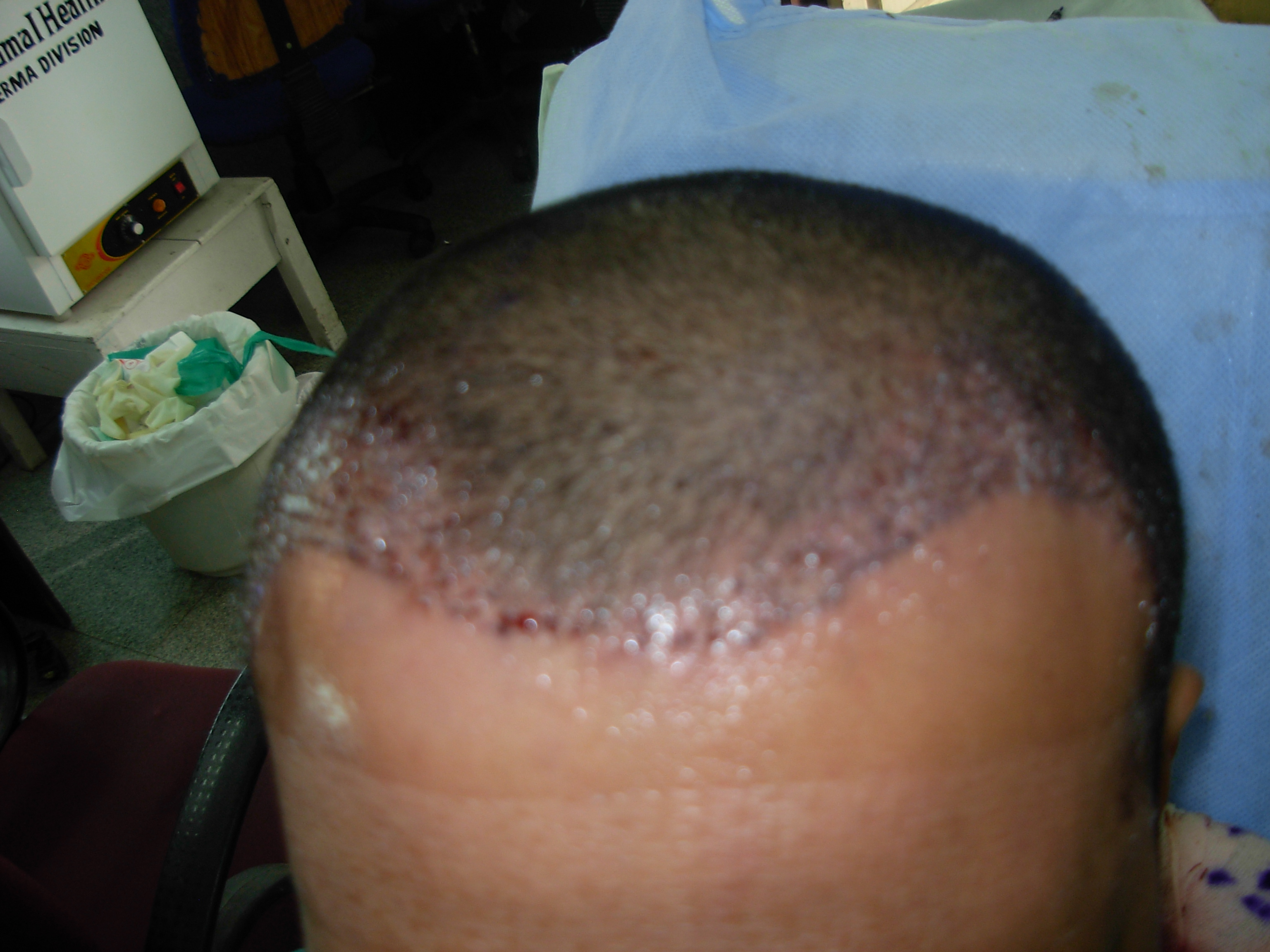 Sarvad Skin & laser center Kuvempunagar Mysore