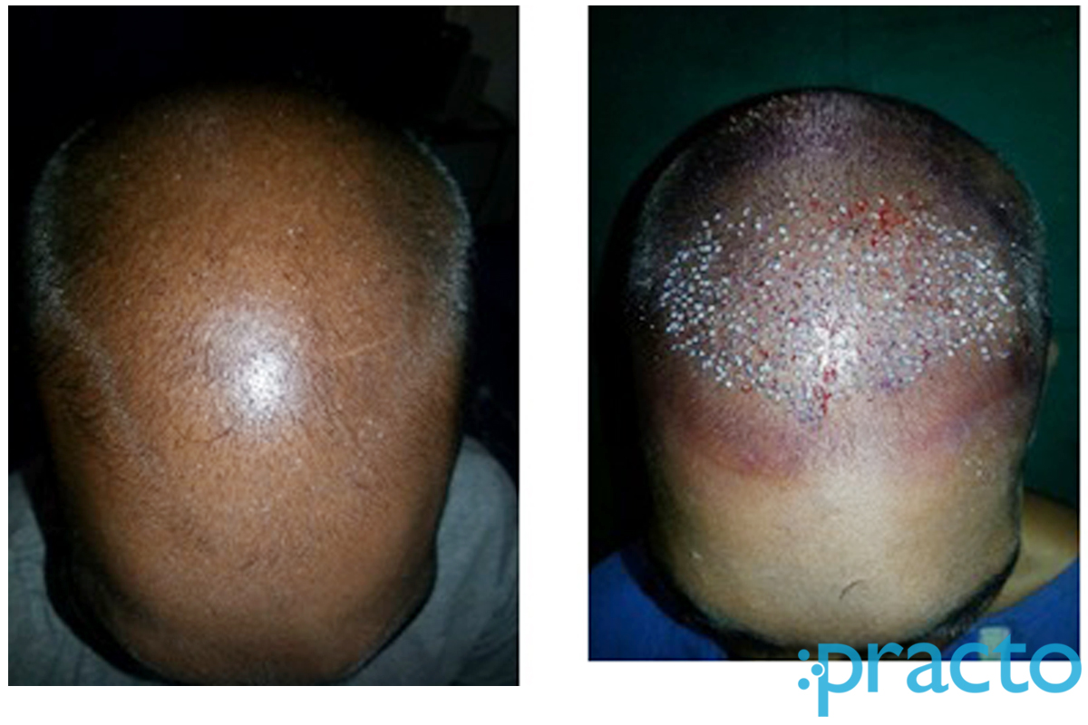 Praseedha Hair Transplant Clinic T Nagar Chennai