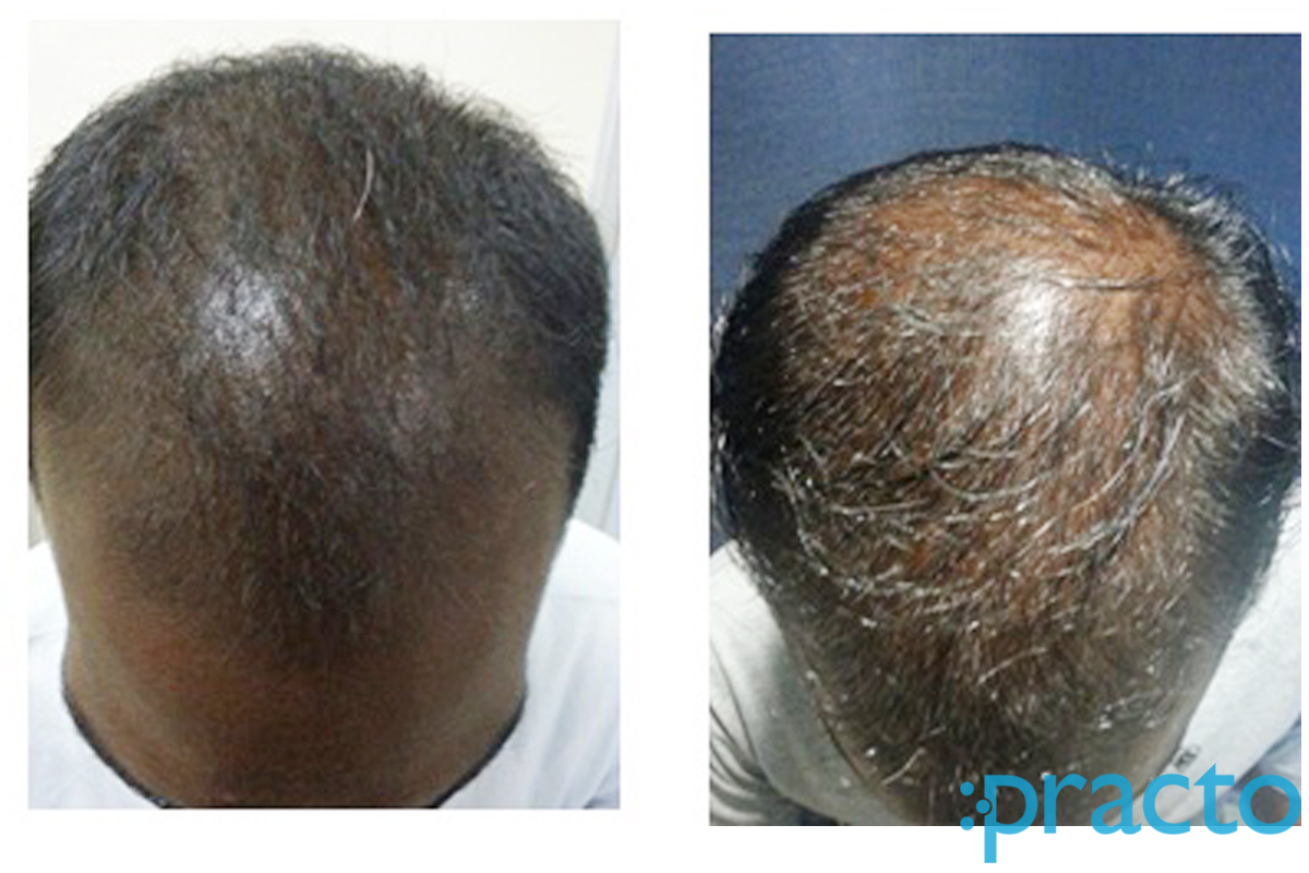 Praseedha Hair Transplant Clinic T Nagar Chennai
