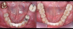 PureSmiles Dental Clinic & Implant Center Baner Pune