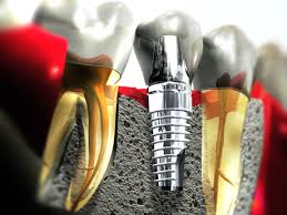 Perfect Dental Clinic Govindpura Bhopal