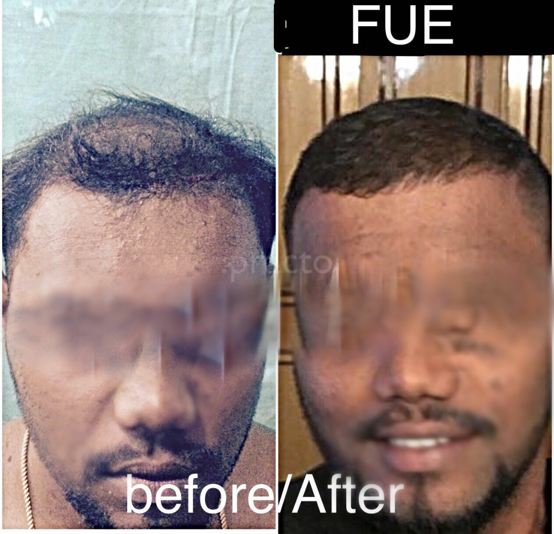 Advanced FUE Hairtransplant Centre Washermenpet Chennai