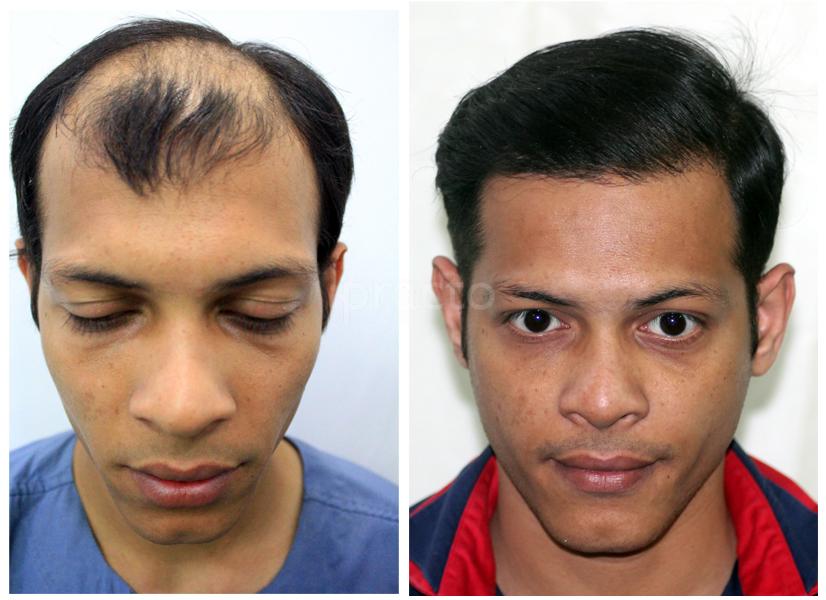 Anagen Hair Transplant Andheri West Mumbai