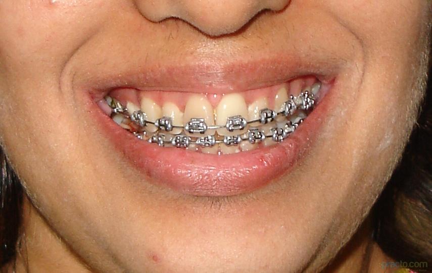 Aline Orthodontic Clinic Kandivali West Mumbai