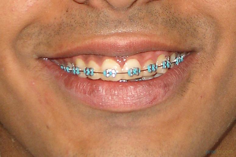 Aline Orthodontic Clinic Kandivali West Mumbai