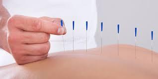 ISHEN VARMA ACUPUNCTURE CLINIC Pulianthope Chennai