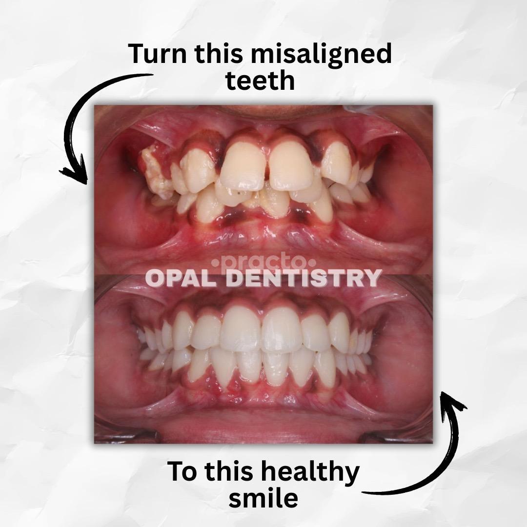 Opal Dentistry Nungambakkam Chennai