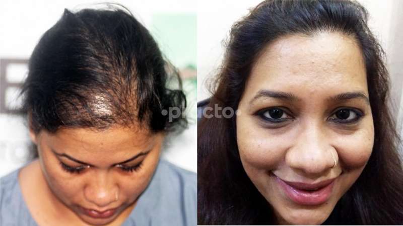 Anagen Hair Transplant, Hair Transplant Surgery Clinic in Andheri West, Mumbai - Book Appointment, View Fees, Feedbacks | Practo Anagen Hair Transplant, Hair Transplant Surgery Clinic in Andheri West, Mumbai - Book Appointment, View Fees, Feedbacks | Practo