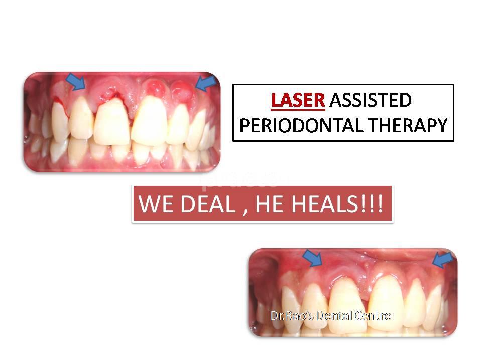 Marketing Poster at Dr. Rao's Dental Centre ® JP Nagar Bangalore