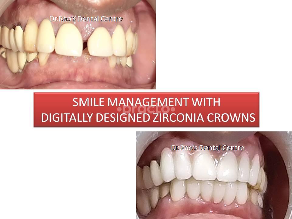 Marketing Sticker at Dr. Rao's Dental Centre ® JP Nagar Bangalore