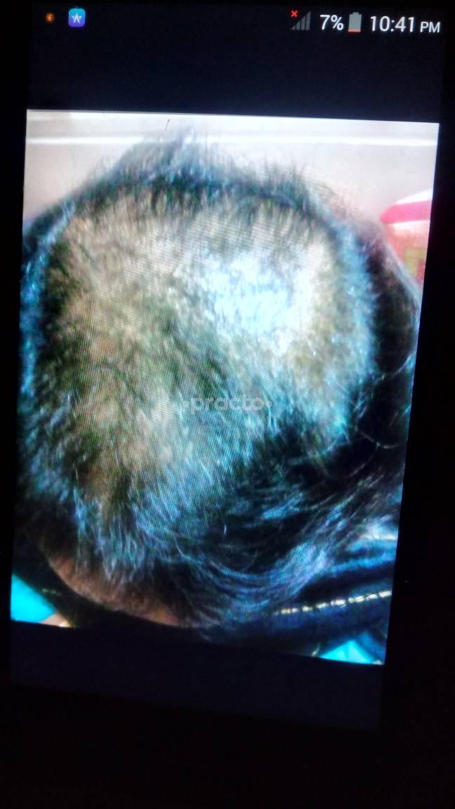 Accu Hair Treatment Jayanagar 4 Block Bangalore
