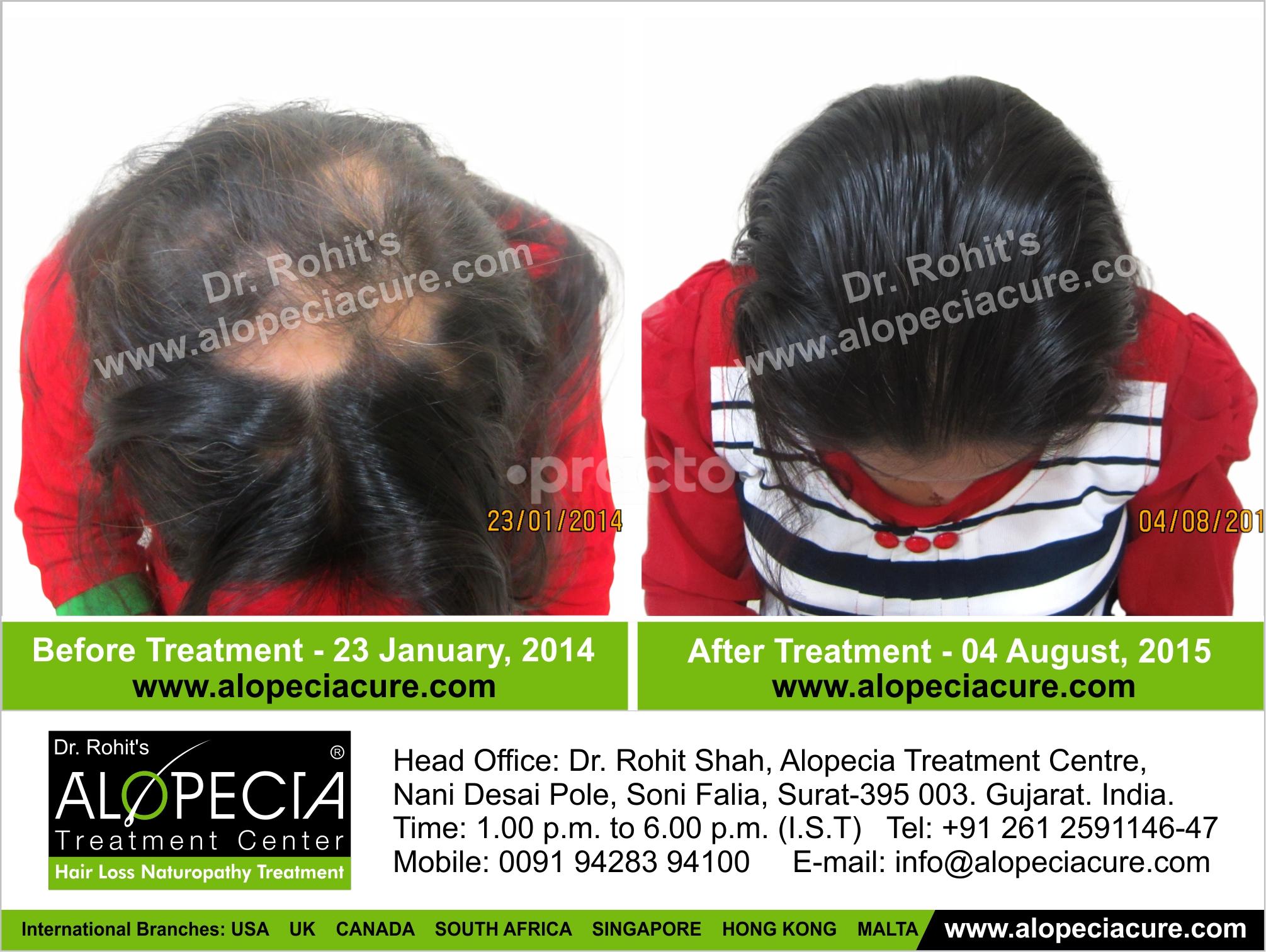 Alopecia Treatment Center Andheri East Mumbai