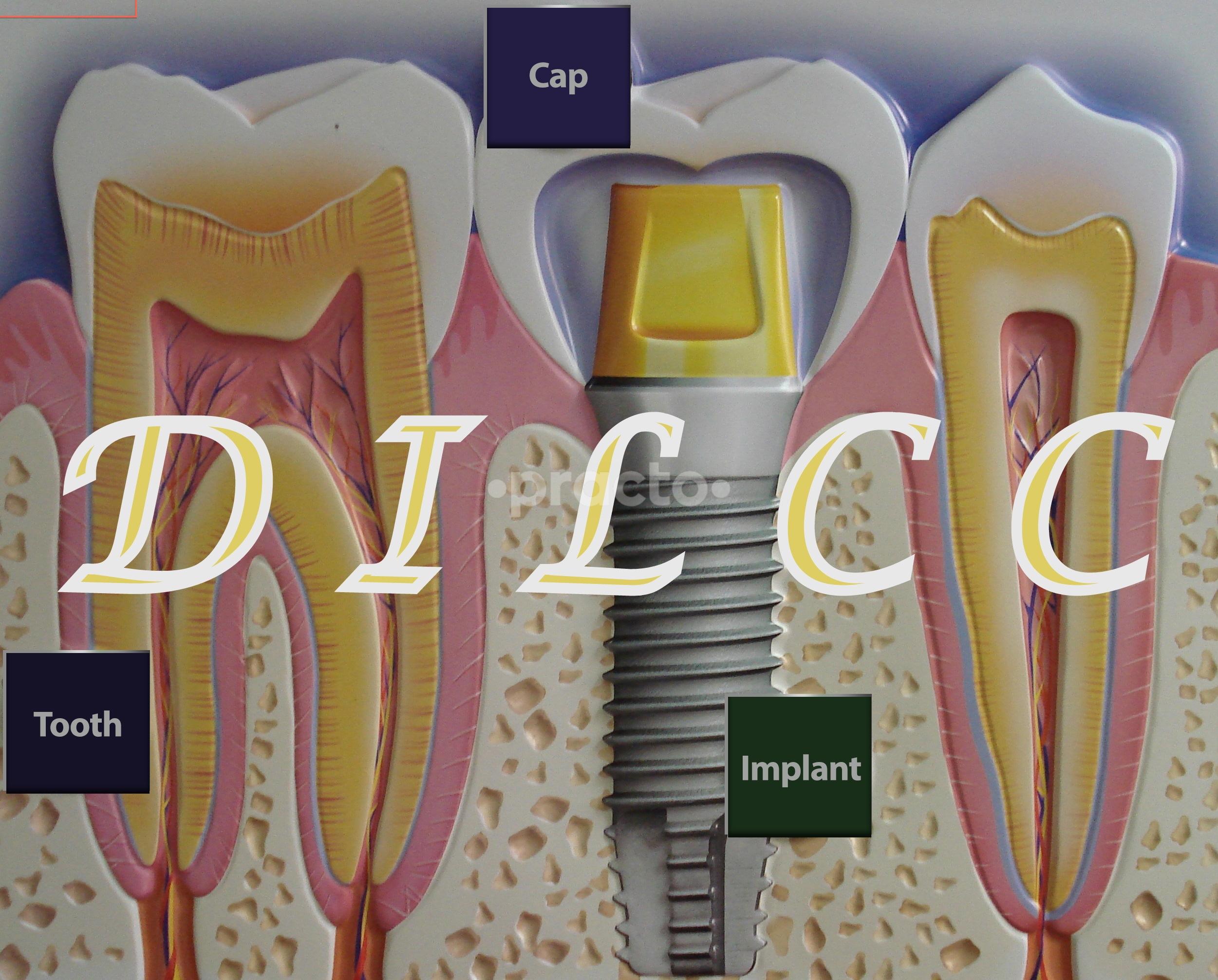 Dental Implant Laser Cosmetic Centre